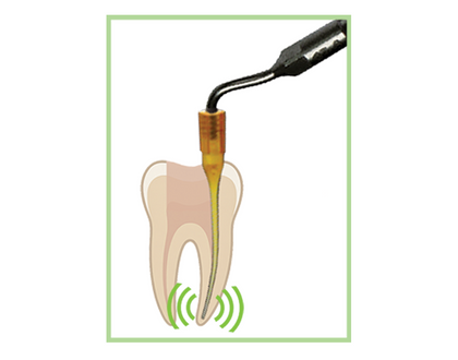 Demonstration of DX-Ultra : Ultrasonic Irrigation