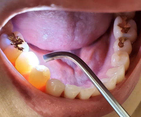 Transilluminating tip illuminating patients teeth.
